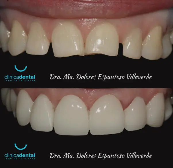 Caso clínico carillas de cerámica